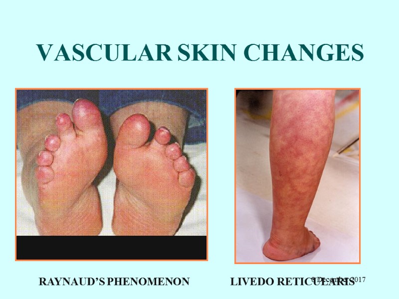 VASCULAR SKIN CHANGES RAYNAUD’S PHENOMENON         